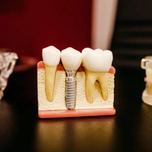 Dental Implants and their role in Restoring your Smile