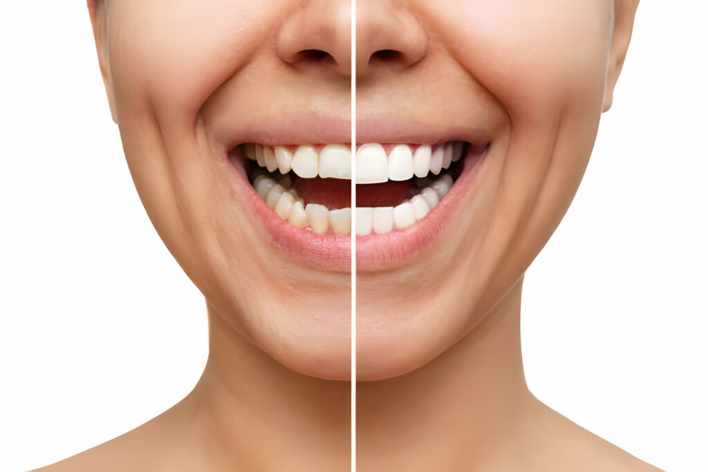 Does Teeth Whitening Professionally Really Work?_1