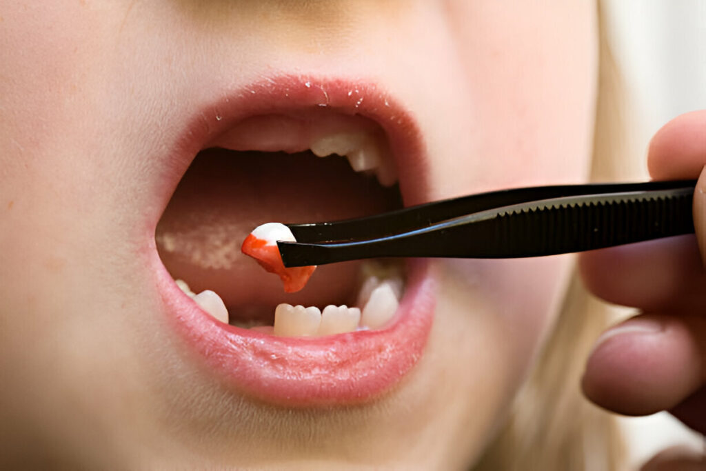 The Ultimate Guide to Tooth Extraction in Garland, Texas – Expert Advice from North Texas Family & Cosmetic Dentistry_1