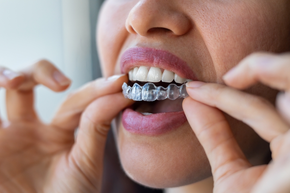 Invialign teeth