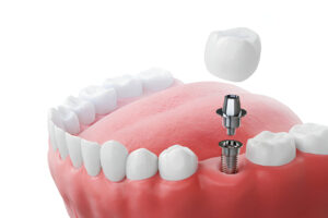 Essential Tips For Your Dental Implant Recovery A Dentist Guide in Garland, TX