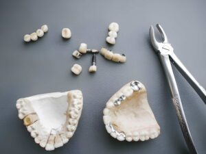 Tooth Replacement Options Explained: A Guide for Garland, TX Patients at North Texas Family & Cosmetic Dentistry_FI